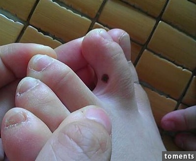 脚趾黑素瘤图片