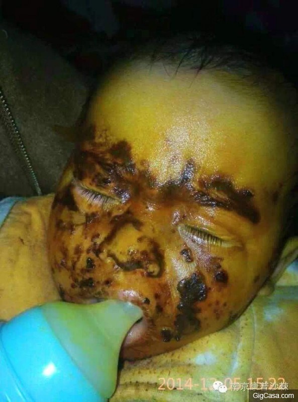一歲小孩的臉被燙傷到80%，竟然用了『這個東西』臉完全好了！分享出去讓更多的人知道