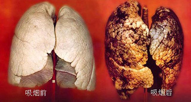吸烟人的肺 十年图片