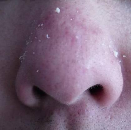 鼻子上起的小疙瘩，擠出的白色物體是什麼嗎？