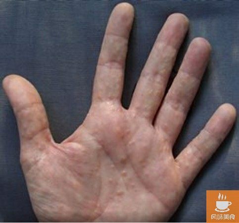 速轉！手指和手掌上長了這樣的皰疹，一定要當心了！速去醫院檢查！分享給身邊的人看看吧！