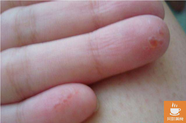 速轉！手指和手掌上長了這樣的皰疹，一定要當心了！速去醫院檢查！分享給身邊的人看看吧！