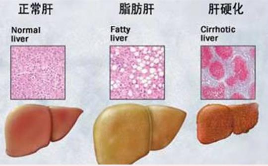 身體出現這5個症狀請儘快檢查你的肝