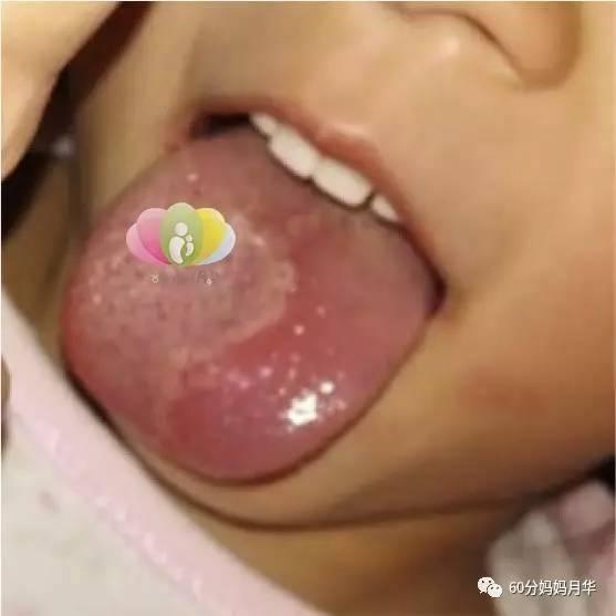 當媽的，一定要懂點舌診知識，這是讓寶寶不生病最便捷的方法