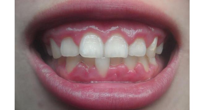 萎縮的牙齦還能「長」回來嗎？