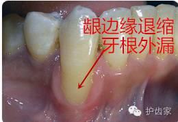 萎縮的牙齦還能「長」回來嗎？
