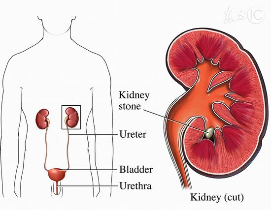 腎臟是人體水處理系統 保護腎臟要做到三點