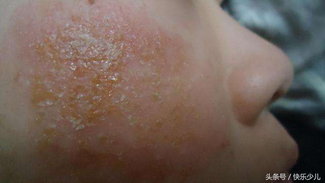 嬰兒最常見的皮膚炎症：尿布疹、濕疹，怎麼樣有效護理