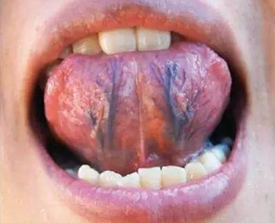 舌下長紫筋，血管易堵塞！一味中藥泡水喝，除淤通血，病痛少！