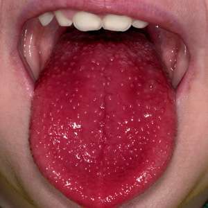 從「舌頭紋路」看出你的健康狀況！出現「這9種狀況」請馬上到醫院掛號！
