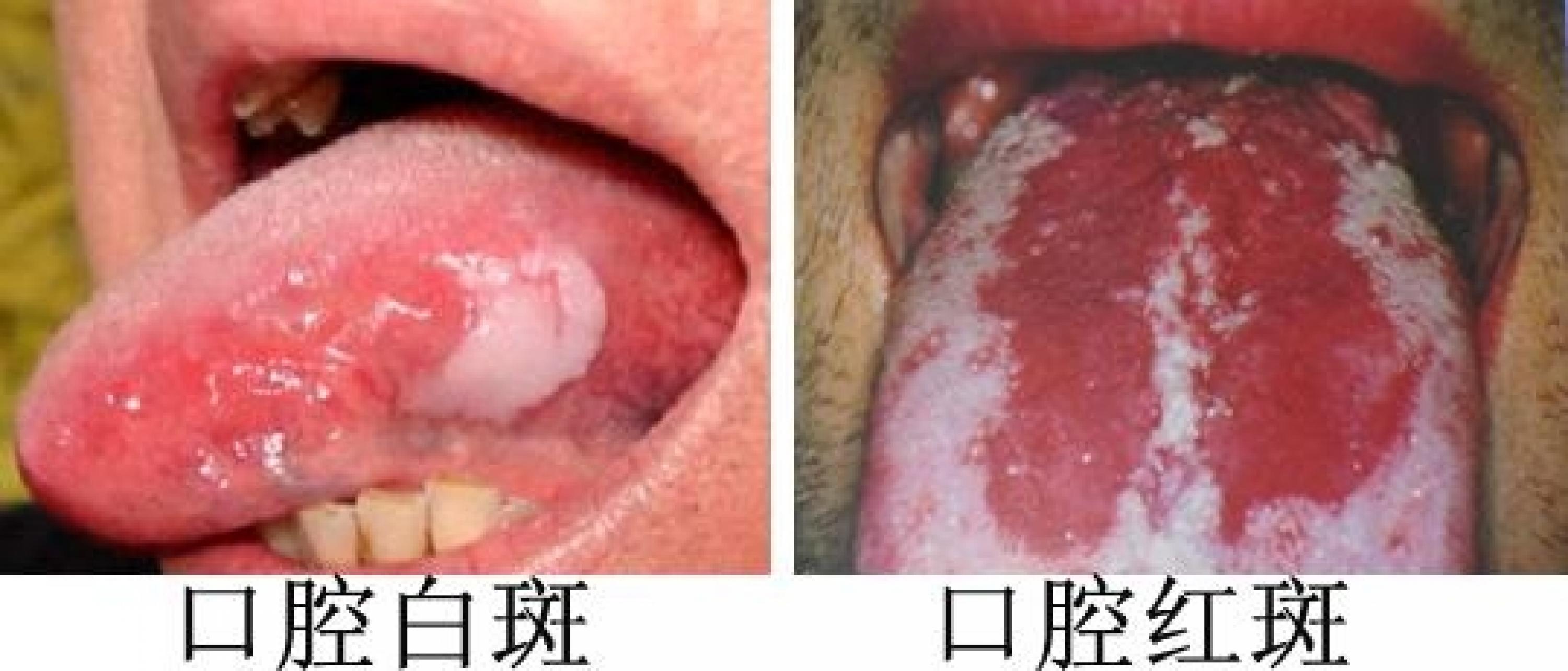 口腔黏膜癌图片