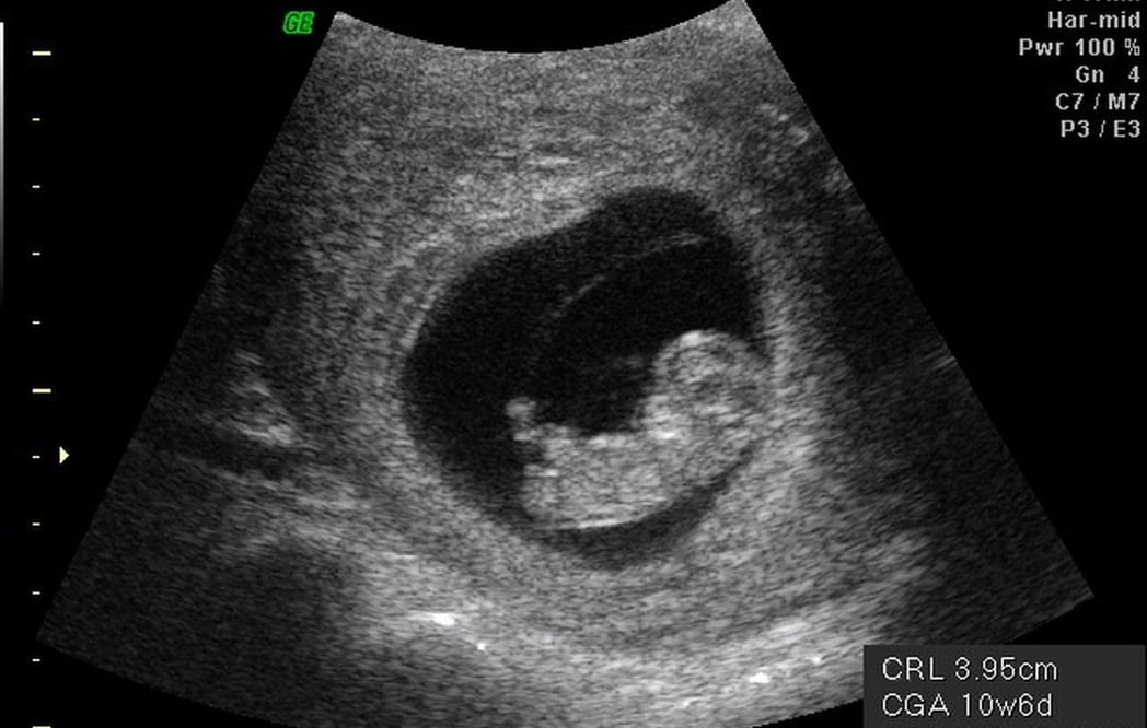 婦女懷孕前三個月，胚胎歷經層層考驗才能發展成形，圖為懷孕十二周的胚胎超影波影像。...