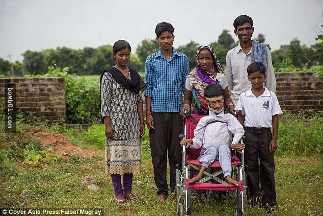 驚！這名印度男孩的「頸部180度倒掛胸前」連家人都寧願要他安樂死，沒想到是一位...救了他！
