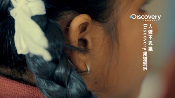 印度少女耳朵痛　醫生清出1千隻螞蟻