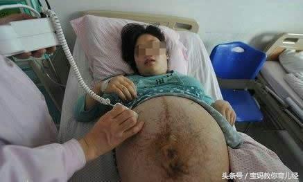 四胞胎孕媽38週遲遲不生，婆婆跪求阻止手術，剖開肚子醫生被嚇暈