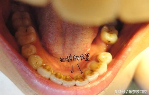 牙齿内侧黄黄的脏东西怎麼去除?