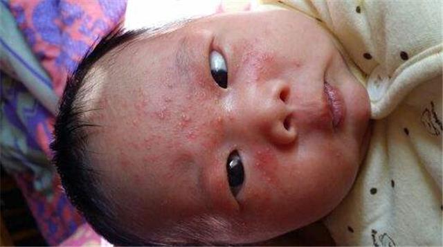 痱子和濕疹的區別是什麼？寶寶熱痱子怎麼治好的快呢？