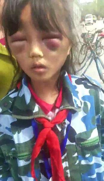 女孩遭繼母打罵成「熊貓眼」 警方稱女孩已被送醫救治，打人者正在接受審訊