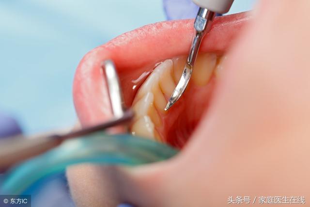 口腔裡有牙結石，對人體有哪些危害？主要有3個