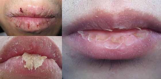 嘴唇時常乾裂的原因是什麼？ 