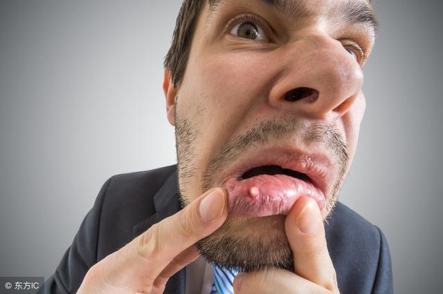 口腔潰瘍頻繁發作是什麼原因？哪些情況的口腔潰瘍要及時就醫？