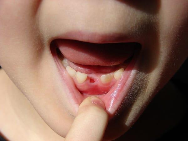 醫生：孩子乳牙掉了別再傻傻丟掉，儲存下來能救命！