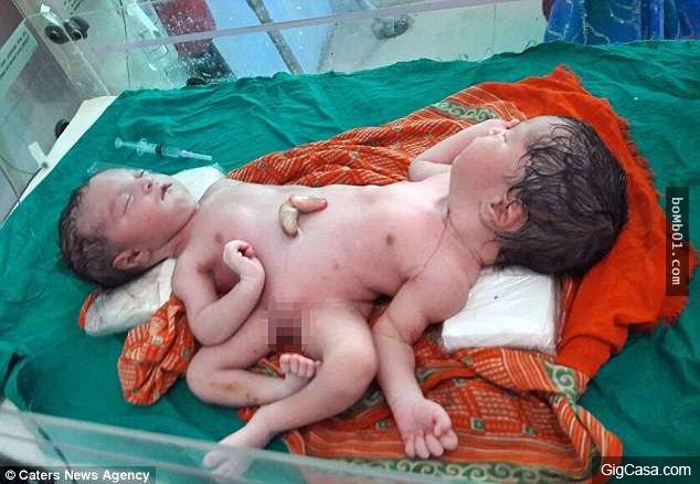 印度父母終於等到雙胞胎出生後卻是悲劇的開始，一看到寶寶的情況時他們都不相信眼睛所見…
