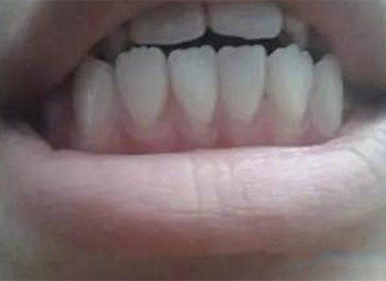 牙齦一旦萎縮，就會出現塞牙，牙根疼痛，4個方法幫到你 !