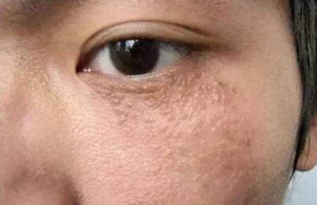 脸上长脂肪粒不要用手挤,教你3个小妙招,就能快速去除脂肪粒!