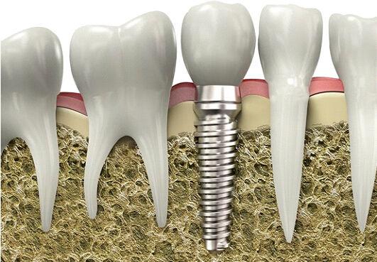 資深牙醫的良心告白，能做假牙就不要植牙！