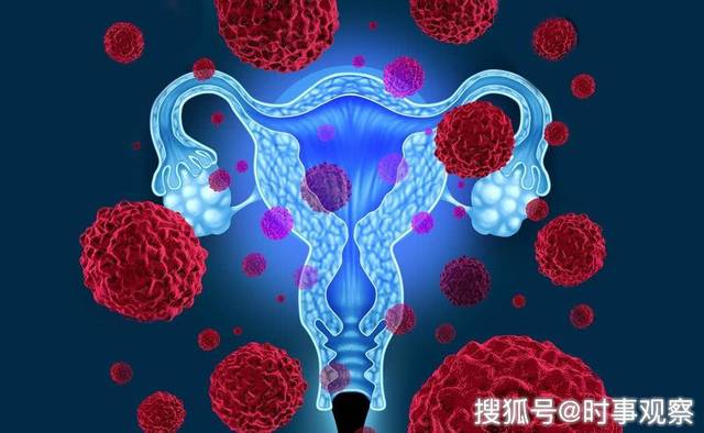 患上宮頸癌早知道：身體出現4個「異象」，女人要格外小心了 !