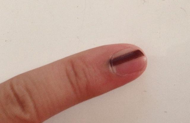 手指甲出現了黑線，不要忽視，可能是癌症早期的信號