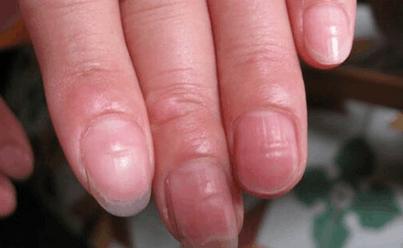 手指甲出現了黑線，不要忽視，可能是癌症早期的信號