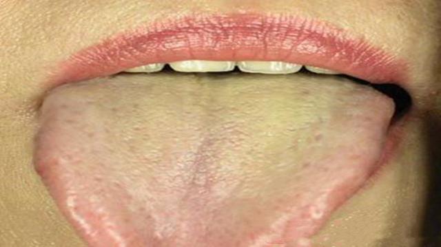 舌頭有這種情況可能是身體出了大問題，快看看你有沒有！