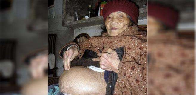 這名老太太今年「90歲」，照X光時醫生嚇出一聲冷汗！「這東西」竟然在她肚子裡待了58年！ 