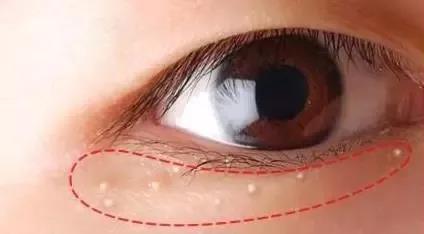 醫生告誡：眼睛出現7個症狀，提示大病潛伏在身體，趕緊上醫院！