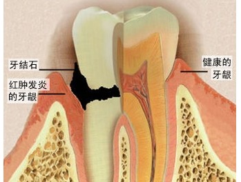 究竟應不應該定期「洗牙」，讓專家解開你多年的疑惑！