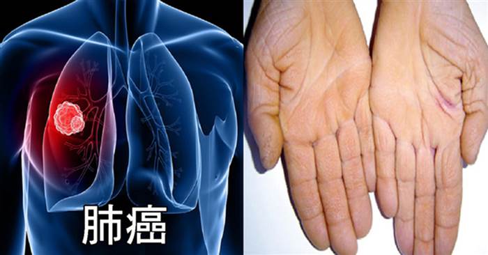 「肺癌」蟬聯8年奪命癌癥第一名！「8大警訊」絕對不可忽略，早期治療存活率高
