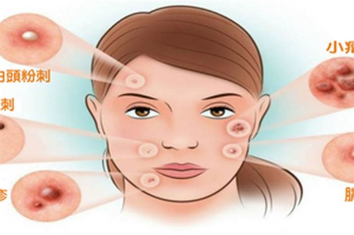 「醫院」治不好的痘痘，「美容院」就能治好？關於『奮痘』，那些不敢說的真相一次公開！