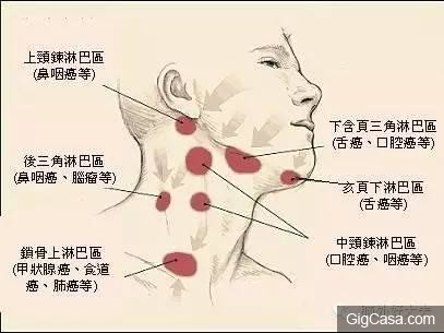 99%的人不知道！脖子有腫塊除了淋巴出問題，竟然還有其他原因！別再嚇自己了！