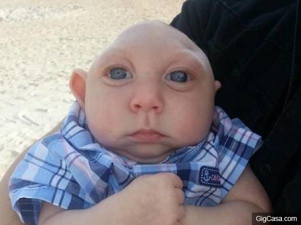 這名患有「平腦症」小男嬰醫生都說沒救了，但他長大後的模樣真的是我看過最可愛的寶寶！