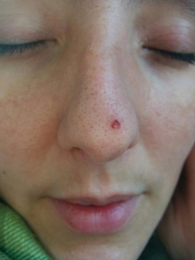 鼻尖一顆小痘最後演變成皮膚癌！夏天不塗防曬霜的朋友醒一醒