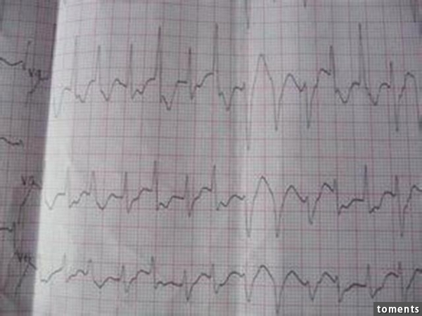 他15年暈倒100多次，以為是癲癇，做完心電圖後醫生嚇壞了