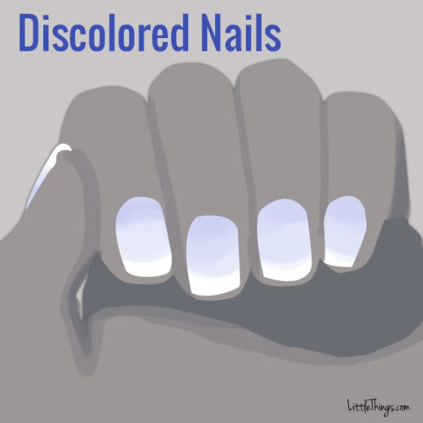 discolorednail