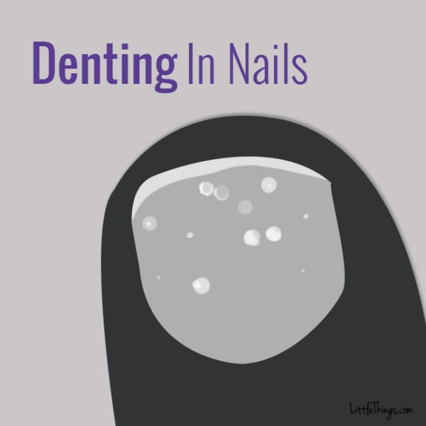 denting