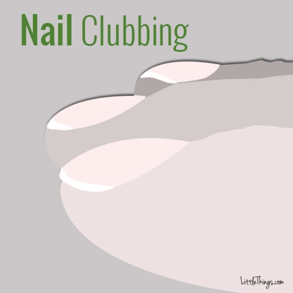 nailclubbing