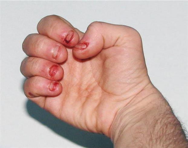 长期啃指甲的危害图片