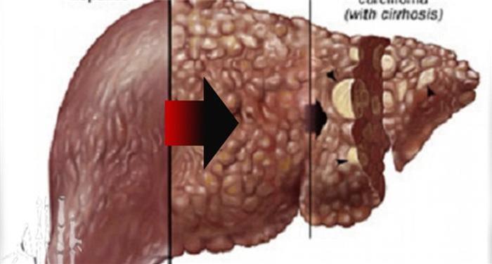 為何「肝癌」一發現就是晚期?你的肝若有這3種症狀,就恐怖了...千萬要注意!!