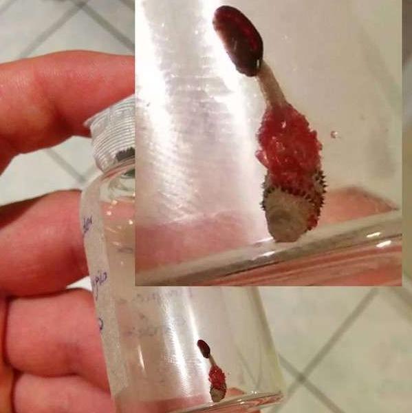 他外出旅行慘遭蚊蟲叮咬到醫院手術,沒想到取出讓人驚訝的東西!