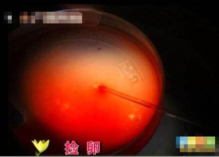 超囧丈夫將自己妻子人工受精完整的全過程曝光，媽媽不易！